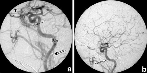 DSA Lateral View Injection Of The Right Common Carotid Artery A