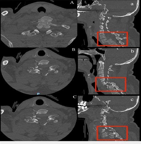 Preoperative Computed Tomography Scan Sagittal Abc And Axial A