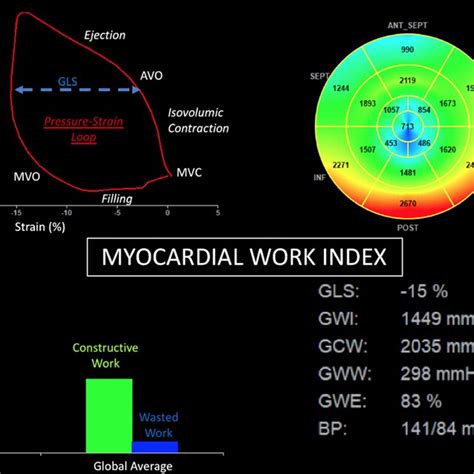 Example Of Myocardial Work Analysis In A Patient With Apical