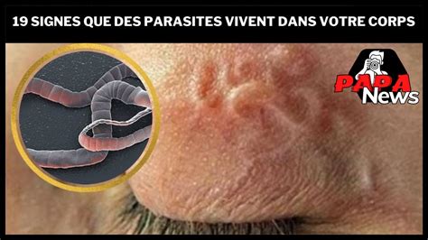 19 Signes Que Des Parasites Vivent Dans Votre Corps YouTube