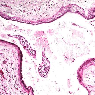 Histological features of the lateral periodontal cyst showing a cystic... | Download Scientific ...