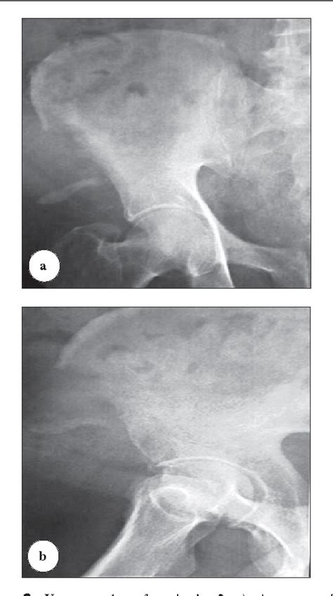 Figure 2 From Fracture Of The Anterior Iliac Crest Following Autogenous Bone Grafting