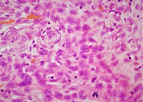 Hande 60× Malignant Stromal Component With Nuclear Pleomorphism
