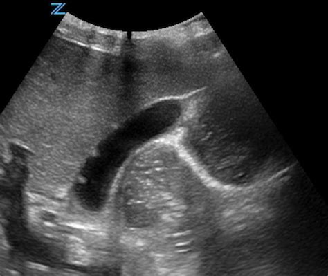 Gallbladder Pathology By Ultrasound Staten Island University