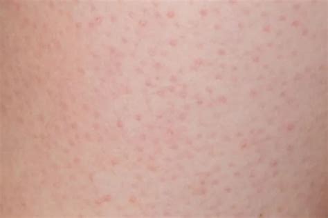 Keratosis Pilaris Causes Symptoms And Treatment Eucerin