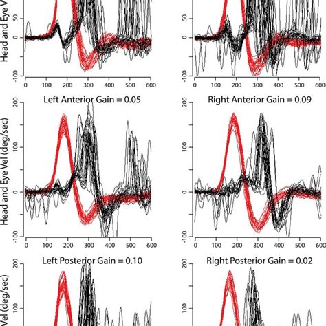 Severe Impairment Of The Vestibulo Ocular Reflex Vor Gain From All