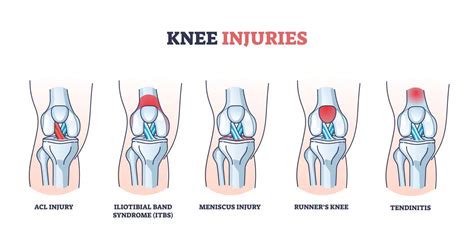 Common Sports and Activities Leading to Knee Tendonitis | The Bone ...