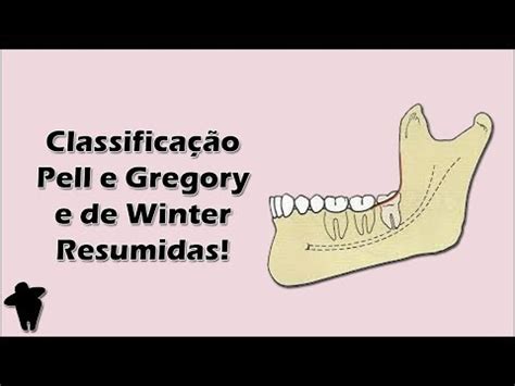 A Real Importância da Classificação de Winter e de Pell e Gregory Para