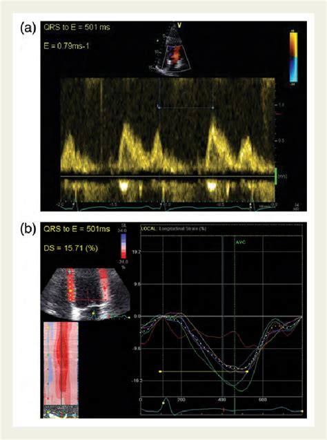 Figure 1 From Altered Left Ventricular Longitudinal Diastolic Function