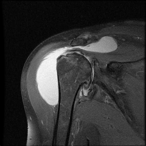 Subdeltoid Bursitis Ultrasound Findings