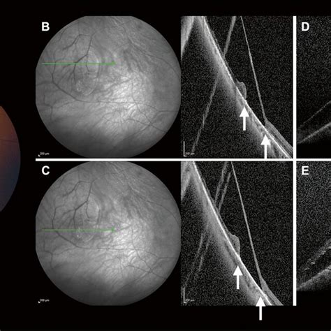 Outer Wall Holes Demonstrated By Sd Oct A Peripheral Fundus Photograph