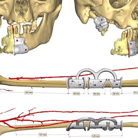 Surgical Planning Example Mandibular And Fibular Cutting Guides