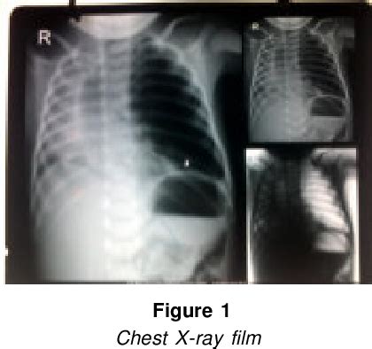 Figure From Anaesthetic Management Of A Case Of Congenital Lobar