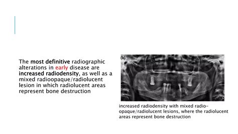 Osteoradionecrosis Of The Jaws The Modern Management Ppt