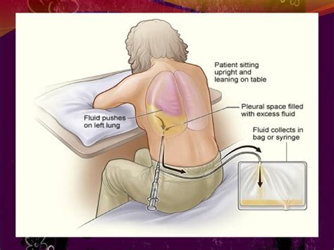 Thoracentesis