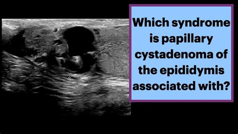 Papillary Cystadenoma Of The Epididymis Von Hippel Lindau Radiology Vhl Urology Youtube