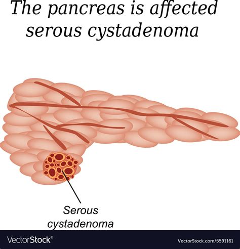 The Pancreas Is Affected Serous Cystadenoma Vector Image