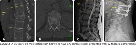 Figure 1 From Thoracoscopically Assisted Vertebral Reconstruction