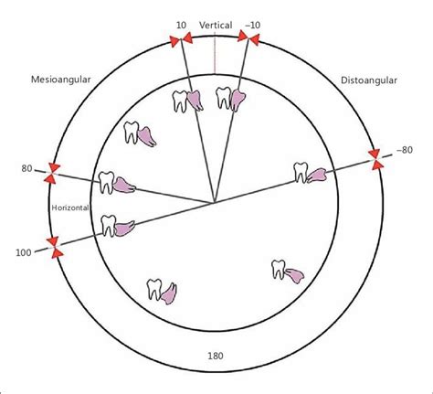 Angulations Of Impacted Third Molars In Relation To Second Molar