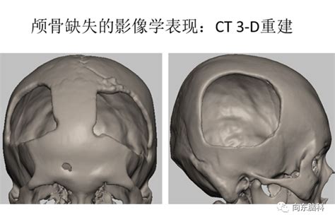 开颅手术要去除颅骨后，缺损选用什么材料修补比较好？智慧康养杭州康复医院，康复中心，养老院哪家好，前十名，价格一览表，排行榜 杭州康复养老平台