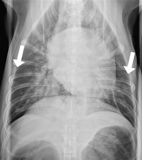 Chest X Ray Pleural Effusion Interpretation