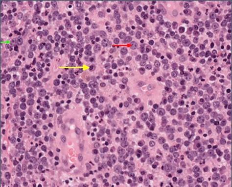 High Power View Showing Abundant Large Lymphocytes With The Morphology