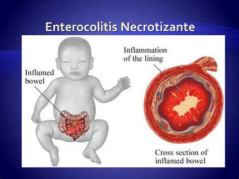 PPT Enterocolitis Necrotizante ECN PowerPoint Presentation Free