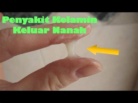 Obat Kencing Keluar Nanah Kencing Sakit Dan Ujung Penis Keluar Nanah