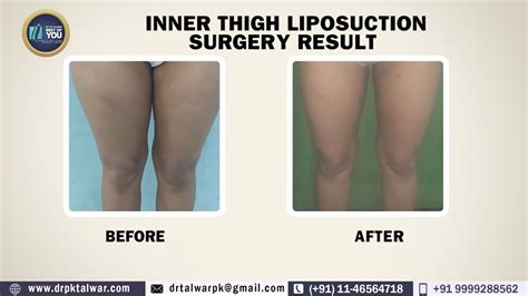 What To Expect After Liposuction On Inner Thigh Live Inner Thigh