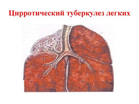 Клинические формы вторичного туберкулёза: кавернозный и фиброзно ...