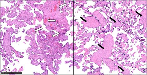 The Pathological Diagnosis Of The Placenta Indicated Fetal Thrombotic