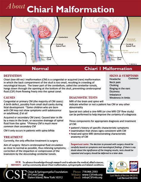 Chiari Malformation One Page Information Sheet Chiari Malformation Chiari Chiari Awareness