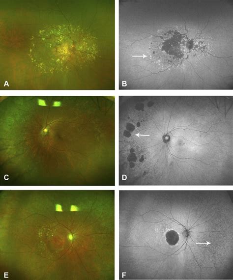 Color And Autofluorescence Photographs Illustrating Faf Abnormalities