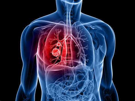 A cancer researcher reflects on the evolution of lung cancer therapies ...