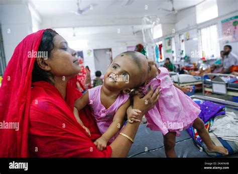 Conjoined Twins Married To One Man