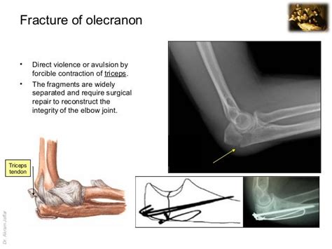 Imaging anatomy fracture of olecranon