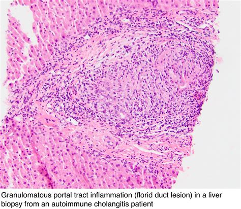 Pathology Outlines Autoimmune Cholangitis