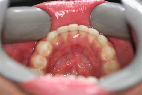 Case 22: Overlapping incisors | Teeth N Braces