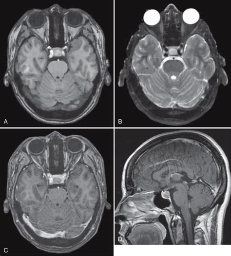 Intracranial Cysts And Cyst Like Lesions Radiology Key