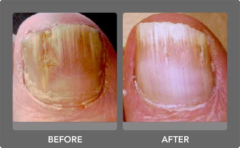 Laser Nail Fungus Removal: Laser Nail Fungus Cure San Diego