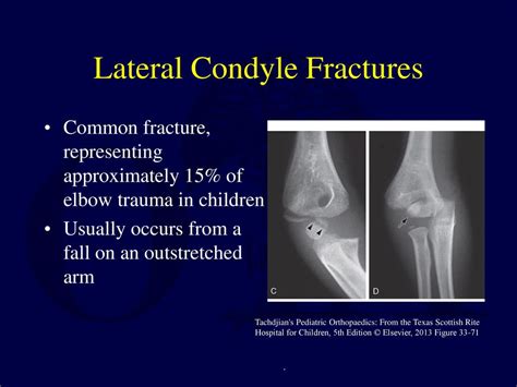 Fractures And Dislocations About The Elbow In The Pediatric Patient