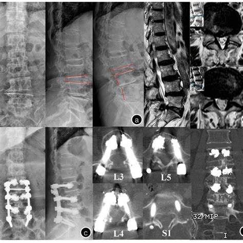 Female75-year-oldT=-3.8 SD a. Preoperative x-ray image showed lumbar... | Download Scientific ...