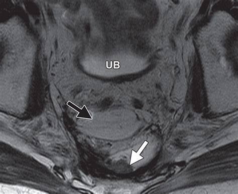 Pelvic Reconstruction With Omental And VRAM Flaps Anatomy Surgical