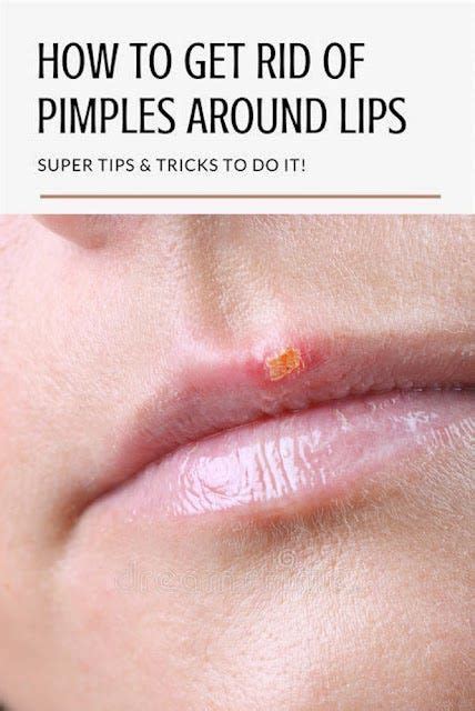 Pimples On The Lips How To Treat Pimples On The Lips Hair Hair