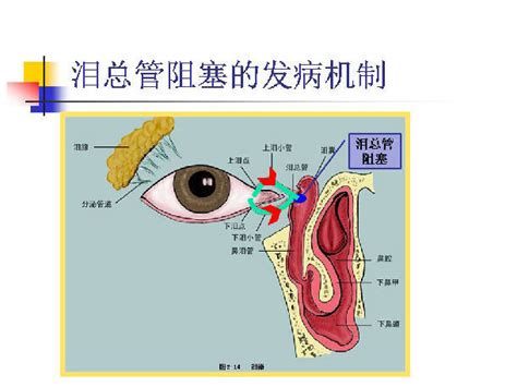 图说 泪道阻塞性疾病的发病机制和治疗方法选择 微医（挂号网）