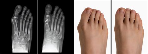 Hallux Valgus Causes Douleurs Traitement Et Chirurgie Cphg Paris