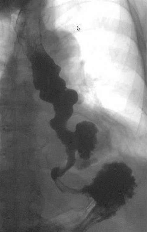 Barium Esophagram Revealing Esophageal Dysmotility And A Large Download Scientific Diagram