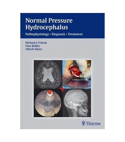 Nph Normal Pressure Hydrocephalus Pathophysiology Diagnosis Treatment 1e Sellular