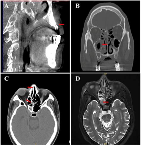 Orbital Apex Syndrome Secondary To Residual Tooth Root Infection A