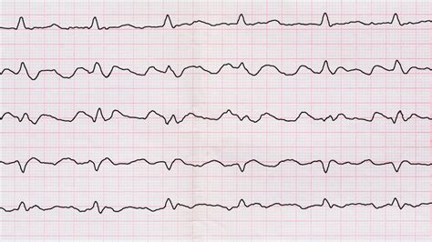 Atrial Fibrillation Awareness Month Hope For Hearts